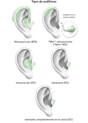 Tipos de audífono - Cobertura
